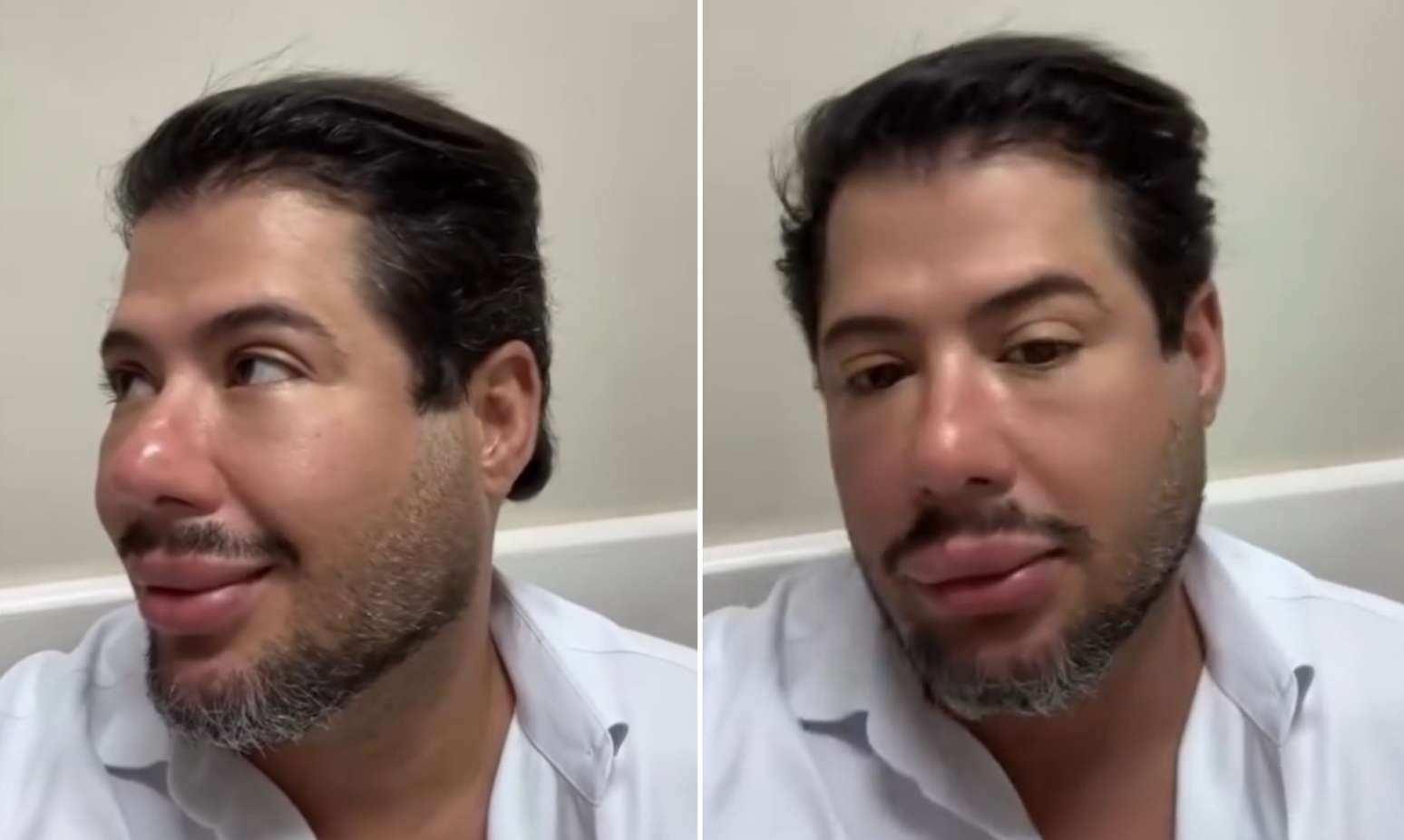 Hugo Alves apareceu com rosto ainda inchad