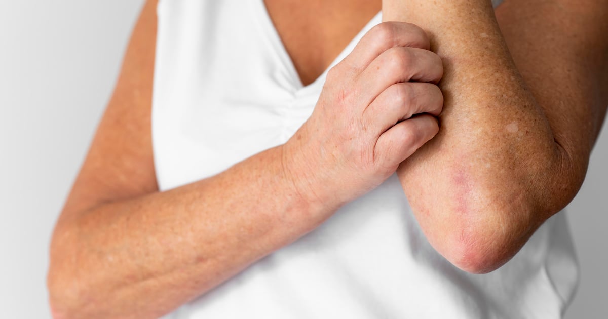 Hanseníase: a doença é antiga, mas a desinformação já deveria ter caducado