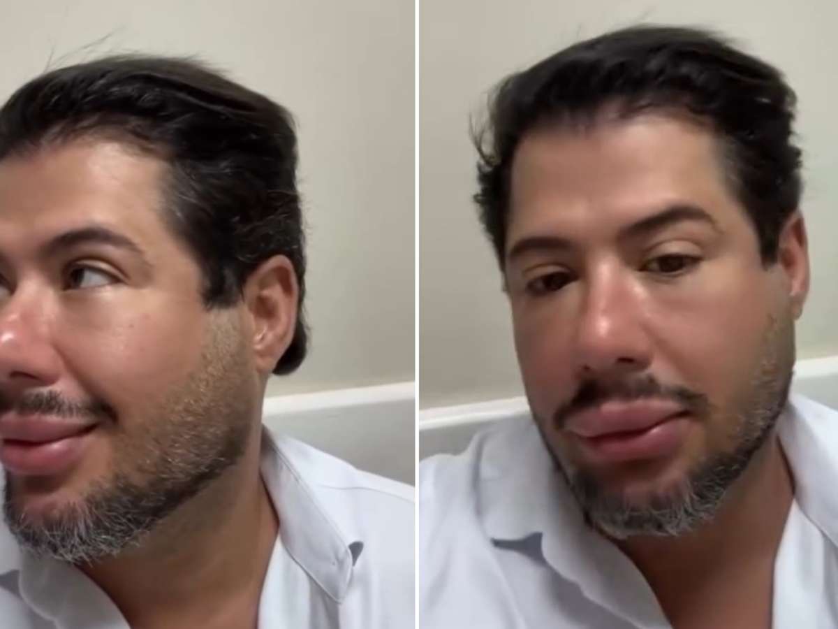 Hugo, da dupla com Tiago, mostra resultado de harmonização