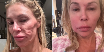 Brandi Glanville ficou com o rosto deformado por conta de suposto parasita Foto: Reprodução/Instagram