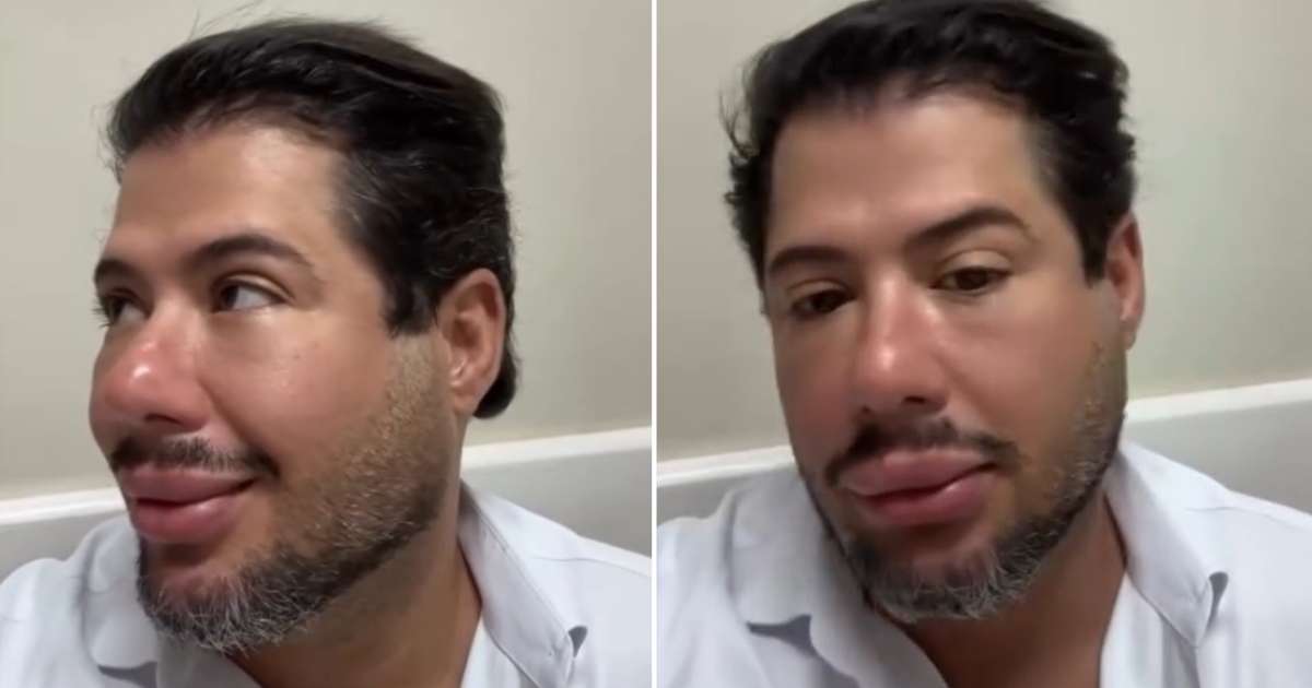 Hugo, da dupla com Tiago, mostra resultado de harmonização