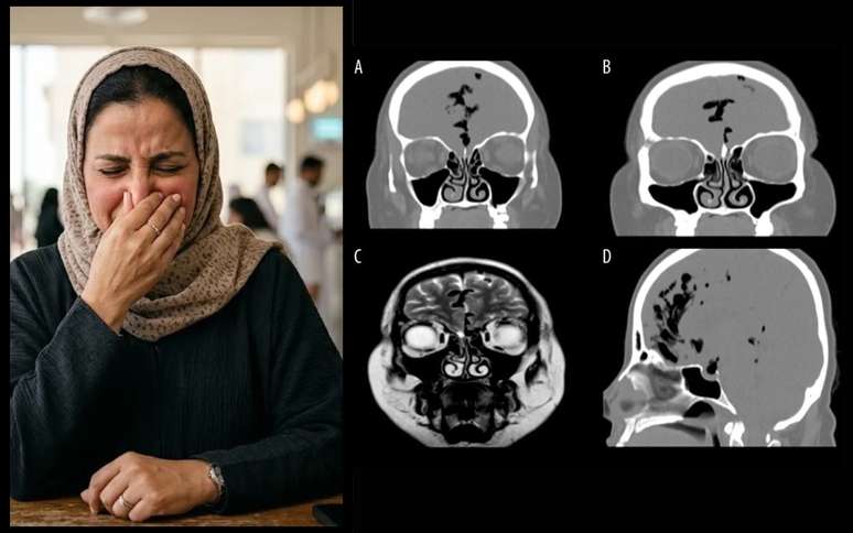 Segurar o espirro faz mal? Mulher de 45 anos descobre ar dentro do crânio
