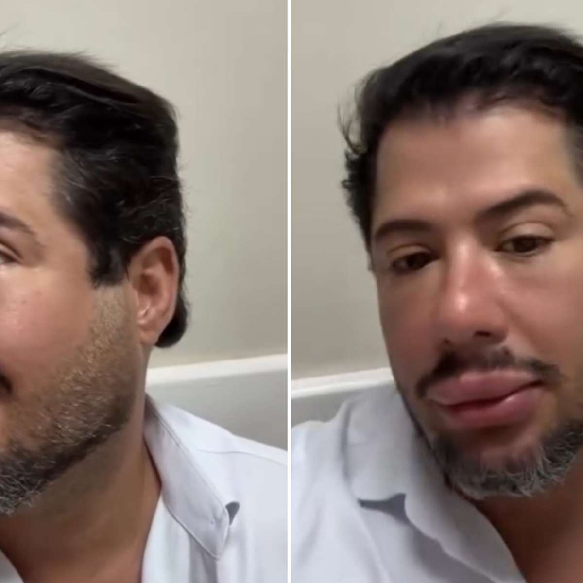 Hugo, da dupla com Tiago, mostra resultado de harmonização