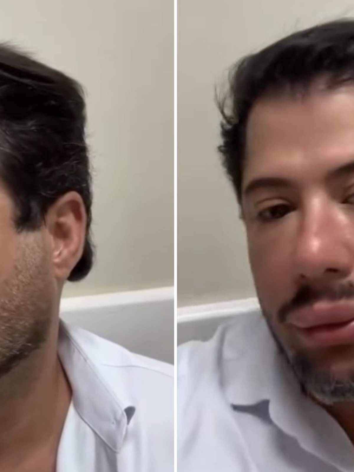 Hugo, da dupla com Tiago, mostra resultado de harmonização